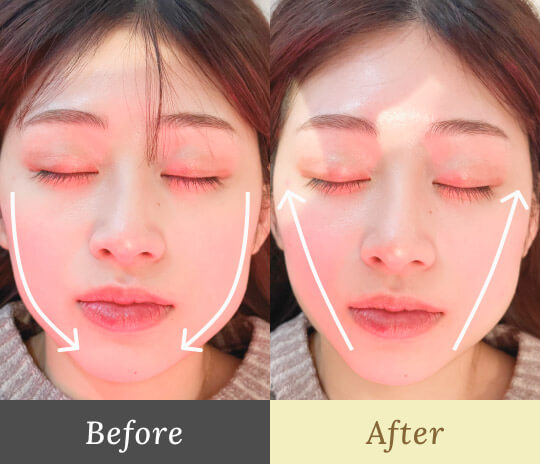Before-After