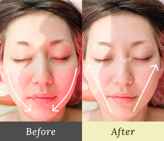 小顔の効果Before-After